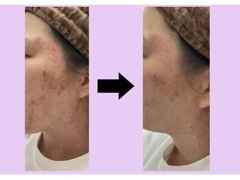 エヌフェイシャル(N.facial)/極度の肌荒れ