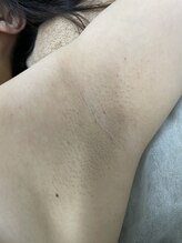 ナノハナ/鹿沼市の全身脱毛のナノハナ