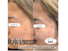 ディアメ(Diame)/ニキビケア★アクネ菌アプローチ