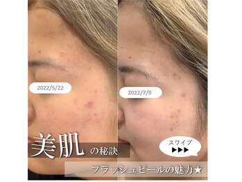 ディアメ(Diame)/ニキビケア★アクネ菌アプローチ