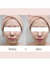 レプス(Lepus)/テスラセラピー(リフトアップ)