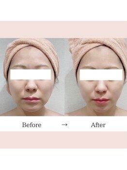 レプス(Lepus)/テスラセラピー(リフトアップ)