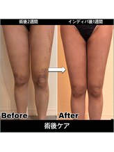 ポノ インディバ サロン(pono. Indiba salon)/即効性アリ！！吸引アフターケア