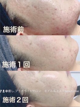 ビューティツリー(beauty tree)/★エルモサハーブピーリング