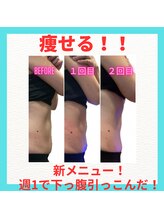 ビービー(BB)/ラジオ波＋バキューム