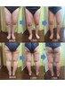☆8月キャンペーン☆ハイパーナイフ＋ハイパーシェイプ2ヶ所　60分