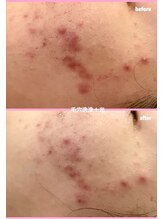 ミレボ(Me.rebo)/毛穴洗浄＋光1回の症例写真