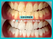 ミルクホワイトニング 長崎中央橋店(Milkホワイトニング)/◆施術例