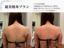 ラブミー 渋谷本店(LoveMe)/骨盤矯正/ハイパーナイフEX/痩身