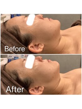 ブローチ 刈谷店(BROOCH)/小顔BHFの効果抜群!