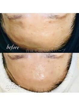 ピアーノ(PIANO)/エルモサハーブピーリング