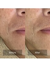 エクラルム(Eclaleum)/BeforeAfter　PHA水光ピーリング