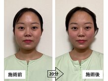 ジェネ鍼灸院/美容鍼