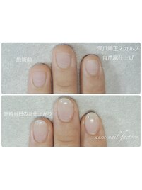 深爪矯正スカルプ《自爪風》赤羽