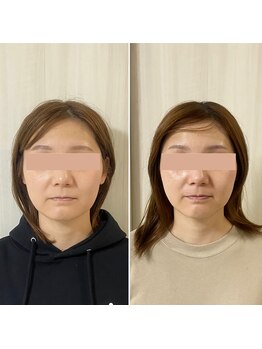 サロン ウェル(SALON WELL)/【30代 小顔矯正/リフトアップ】