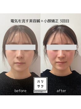 ハリサク/継続施術