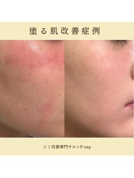 ピーナップ(P-nap)/10代