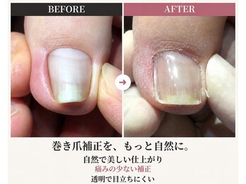ラッコ整骨院の写真/もう繰り返したくない方へ】CLIP-ON補正＋足の使い方まで確認する巻き爪ケア