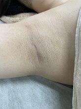 ナノハナ/鹿沼市の全身脱毛のナノハナ