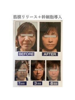 エリーズ(Elise)/たるみ改善コース