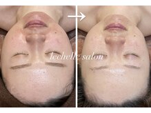 レシェルサロン(Lechelle Salon)/ハイパーナイフ小顔＋ハーブ