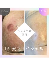 プライベートサロン ヴィヴィアン(Vivian)/光フェイシャル　クイックコース