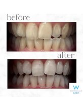 ホワイトニングショップ 広島店(WHITENING SHOP)/【ホワイトニング】Before After