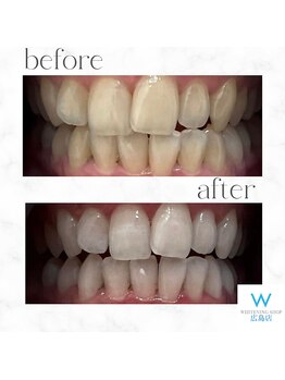 ホワイトニングショップ 広島店(WHITENING SHOP)/【ホワイトニング】Before After