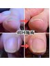 【巻き爪ケア】ご相談　￥2200