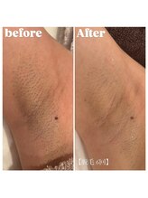 ウィンクドール(Wink Doll)/脱毛コース（ワキ）