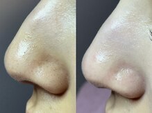 エミュ(emu)/毛穴キレイ♪