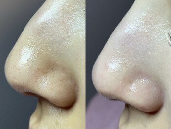 エミュ(emu)/毛穴キレイ♪