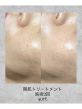 コンクパール(CONCH PEARL.)/陶肌トリートメント