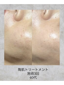 コンクパール(CONCH PEARL.)/陶肌トリートメント