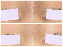 フォーチューン/シミの改善