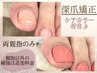 【フット深爪矯正】嬉しい！カラーリングまで♪＜ケア、カウンセリング付き＞