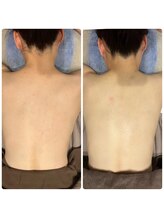 ブリリアント(Brilliant)/ブライダル背中パック