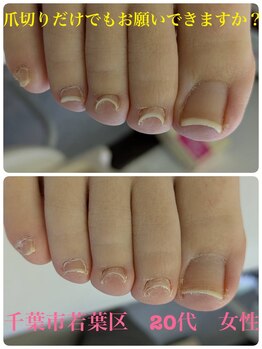 巻き爪じゅん 船橋店/巻き爪を爪切りだけでお願い！
