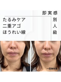 アクアリジェ/脂肪分解液はたるみケアも得意