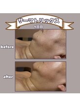 ビーマジック(美magic)/サーマトリックス