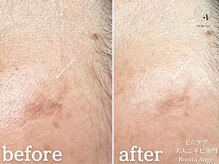 ボニータアンジュ 恵比寿(Bonita Ange)/恵比寿ハーブピーリング｜症例