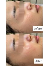 ルラシェ(Relacher)/ハーブピーリング×ポレーション