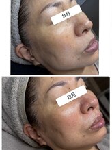 アリィ(Alii)/エンジングに人気トロイピール