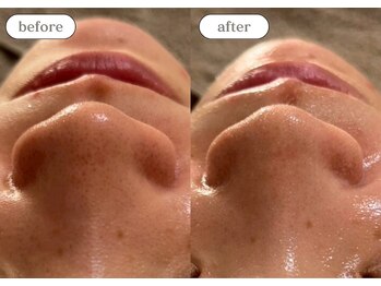 リスタ(RSTA)/【BEFORE/AFTER】