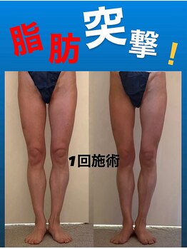 ボーテヌール(Beaute Nheur)/脂肪突撃！