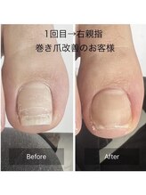 ヴィヴィアンヌ(VIVIANNE)/巻き爪改善