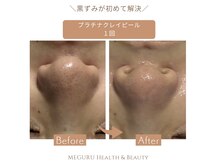 メグル(MEGURU)の雰囲気（プラチナクレイピール1回で黒ずみ毛穴がつるつる鼻に◎）