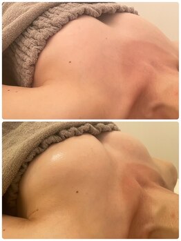 美人バスト 福岡店/バストアップ ◇症例◇