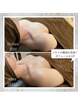 プレミドール(PREMIDOLL)/Before &nbsp;After/施術3回