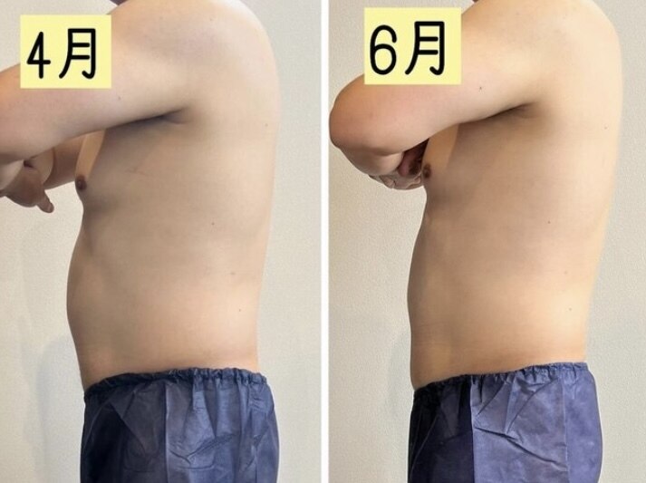 脂肪冷却　クーリング　2カップ 87be487bd995d1447626b395ffb1aa